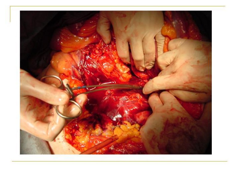 Diapositiva 25 de Accesos vasculares Abdominales