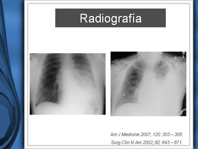 Diapositiva 11 de Empiema Pleural