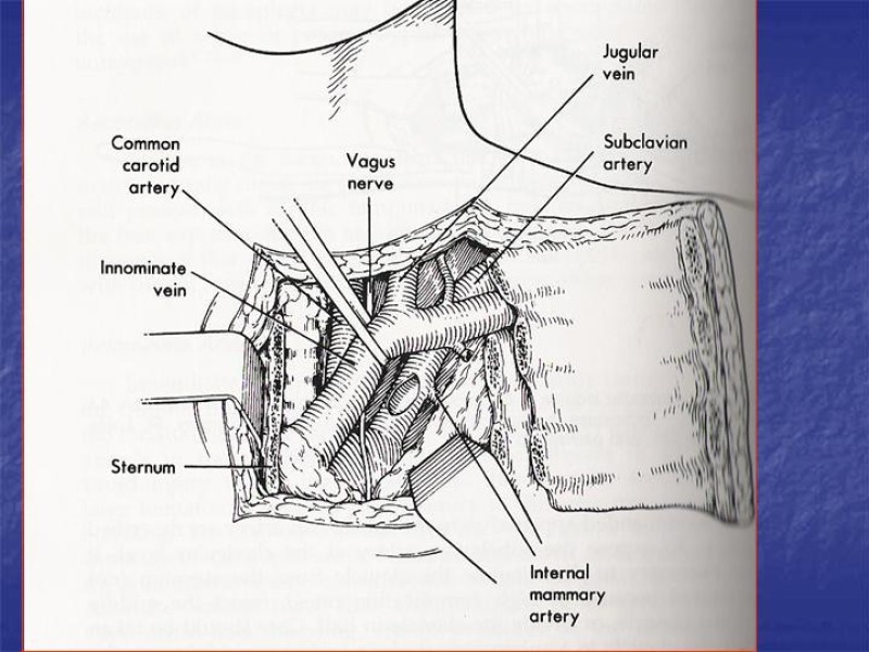 Diapositiva 48 de Abordaje Quirúrgico Vasculares