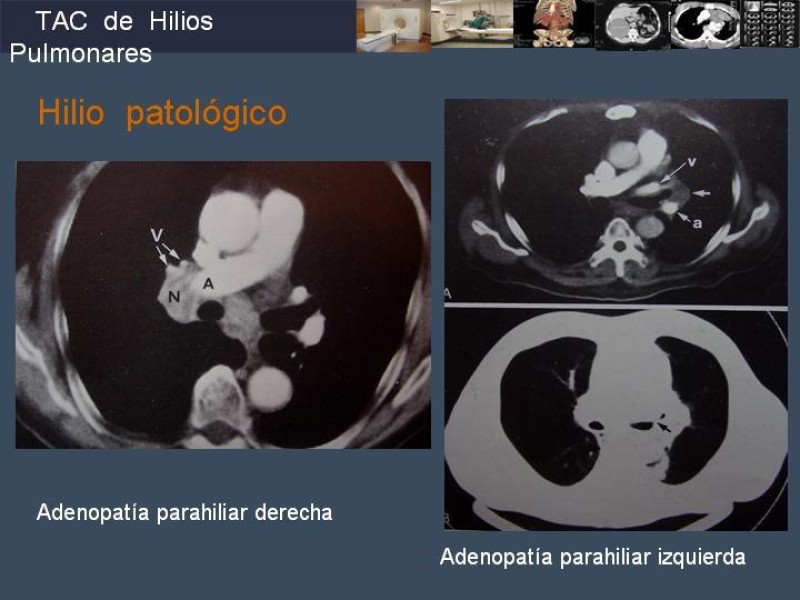 Diapositiva 52 de Imaginología Toráxica TAC