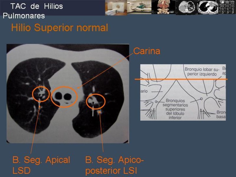 Diapositiva 45 de Imaginología Toráxica TAC