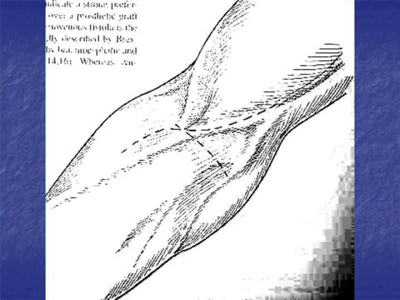 Diapositiva 73 de Abordaje Quirúrgico Vasculares
