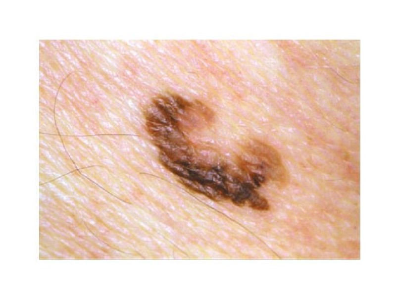 Diapositiva 26 de Melanoma