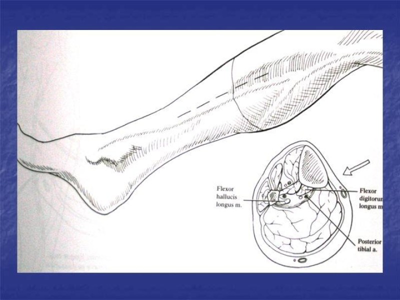 Diapositiva 118 de Abordaje Quirúrgico Vasculares