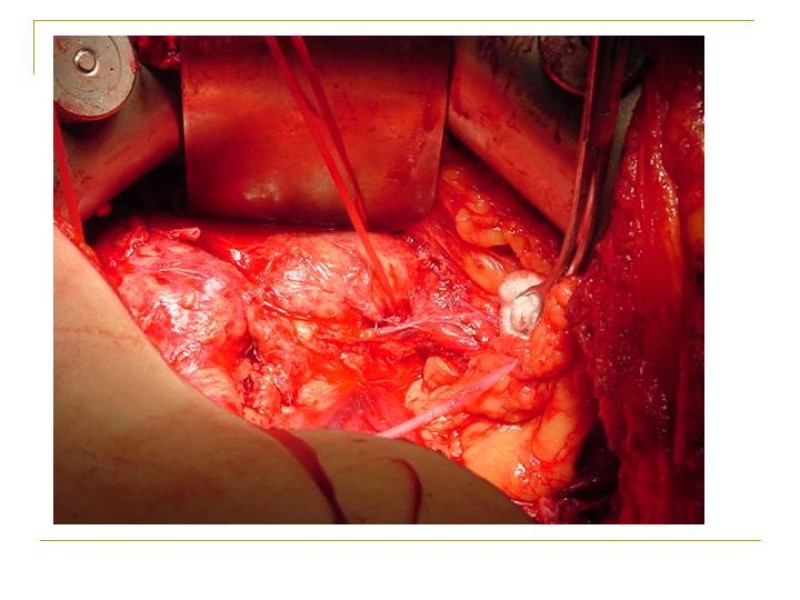 Diapositiva 42 de Accesos vasculares Abdominales