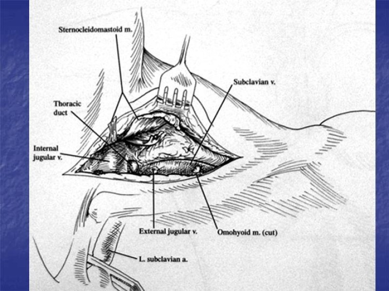 Diapositiva 43 de Abordaje Quirúrgico Vasculares