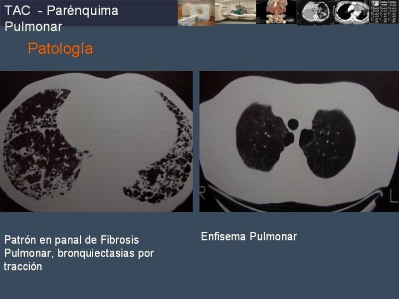 Diapositiva 63 de Imaginología Toráxica TAC
