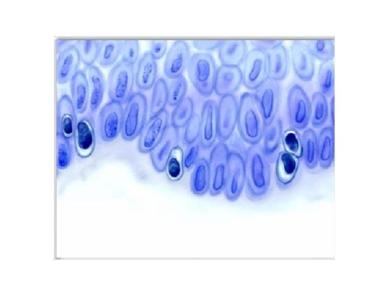 Diapositiva 3 de Melanoma