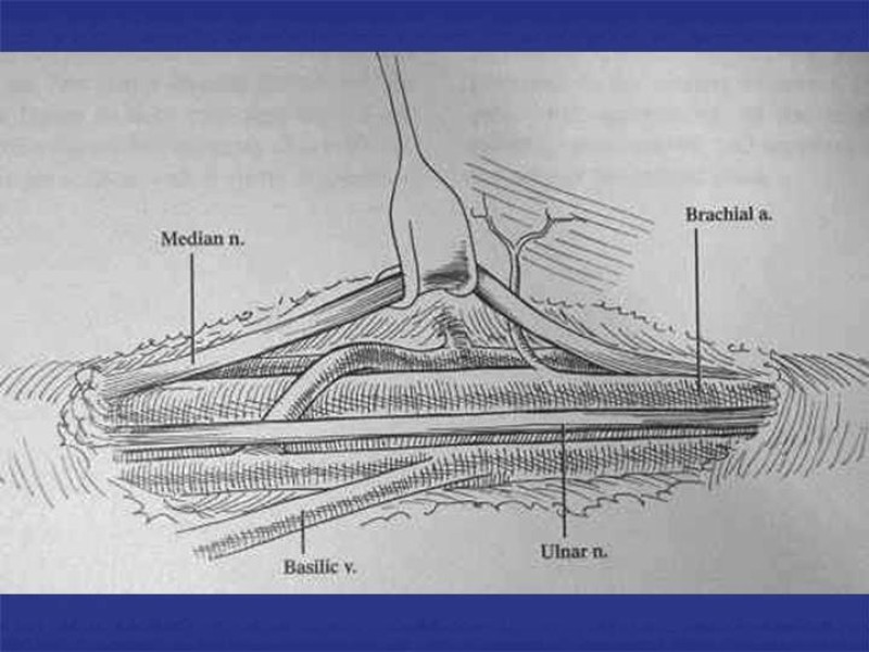 Diapositiva 68 de Abordaje Quirúrgico Vasculares