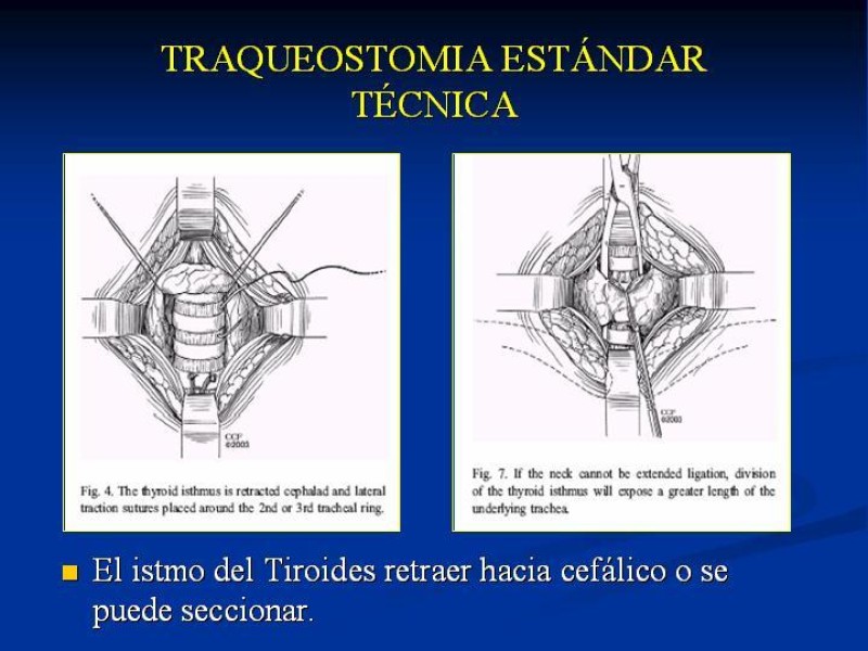 Diapositiva 12 de Traqueostomía Final