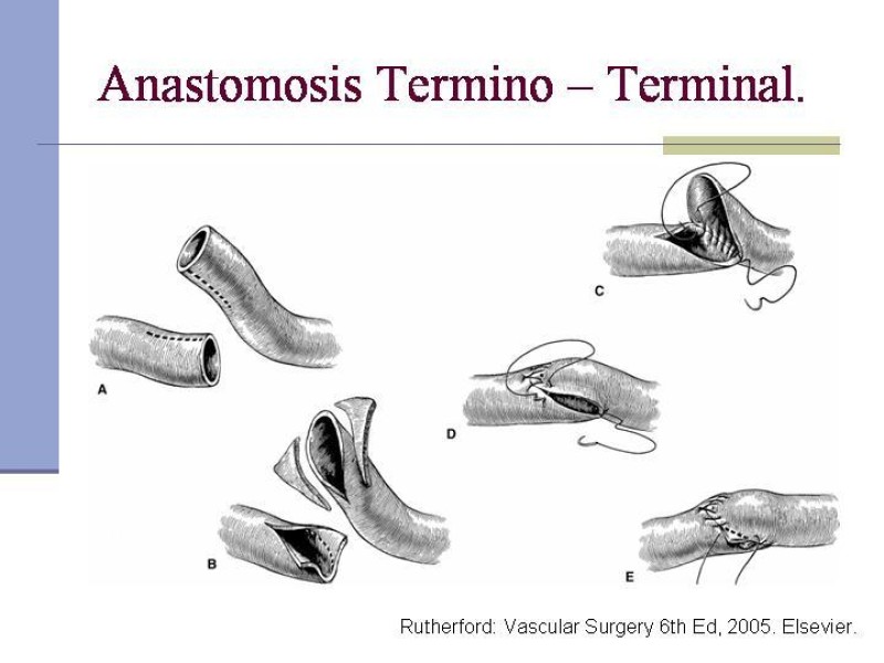 Diapositiva 23 de Reparación y Anastomosis Vasculares