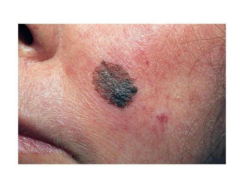 Diapositiva 27 de Melanoma
