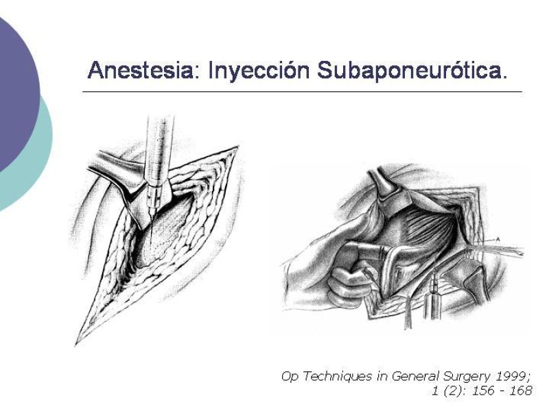 Diapositiva 5 de Hernia Inguinal: Técnica de Lichtenstein