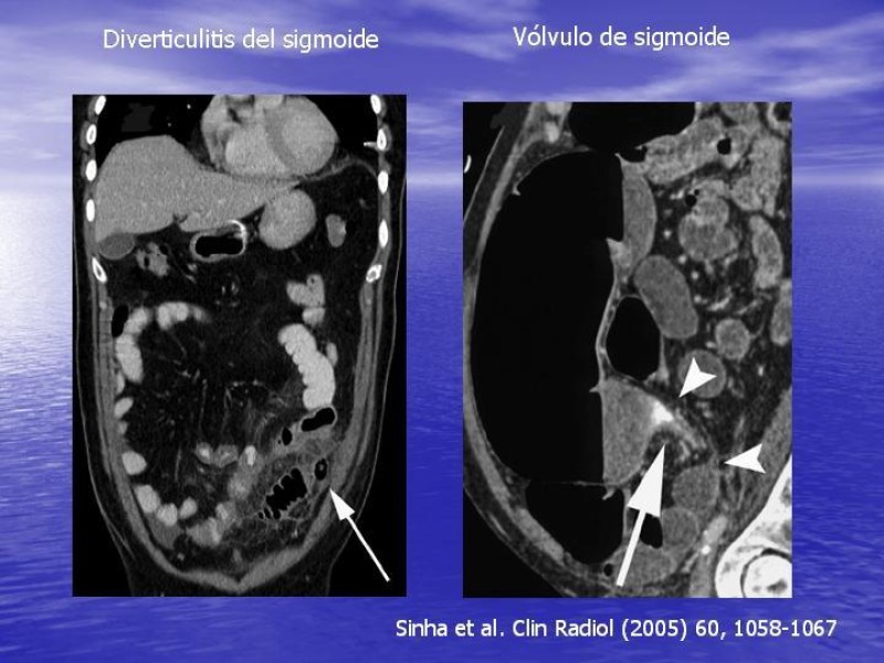 Diapositiva 23 de Obstrucción Intestinal: Estudio Diagnostico y Manejo inicial