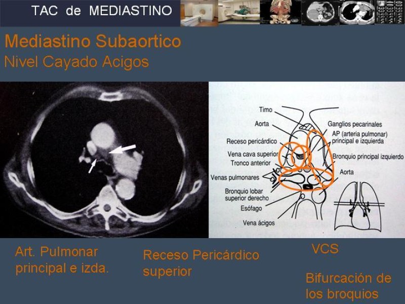 Diapositiva 17 de Imaginología Toráxica TAC