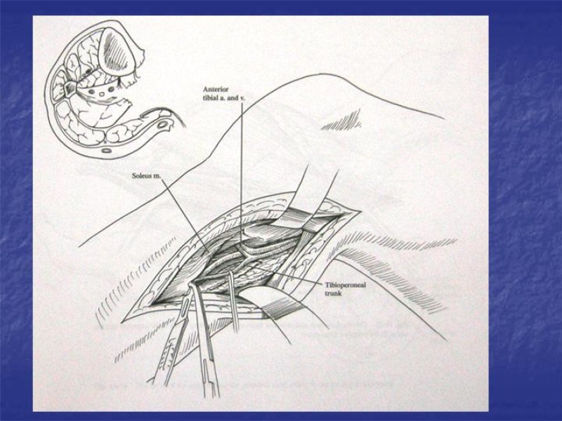 Diapositiva 116 de Abordaje Quirúrgico Vasculares