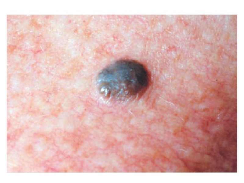 Diapositiva 22 de Melanoma