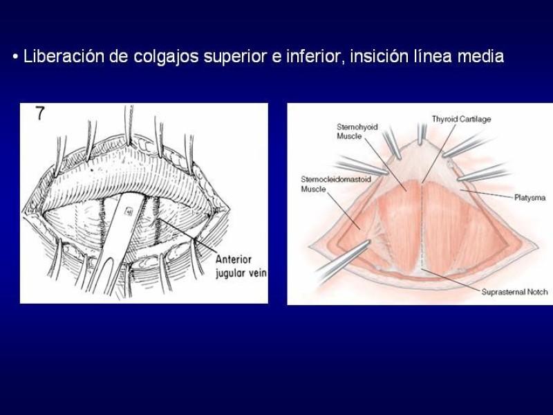 Diapositiva 15 de Tiroidectomía