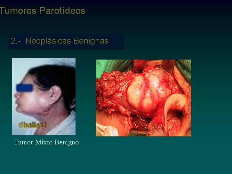 Diapositiva 9 de Masas Parotídeas