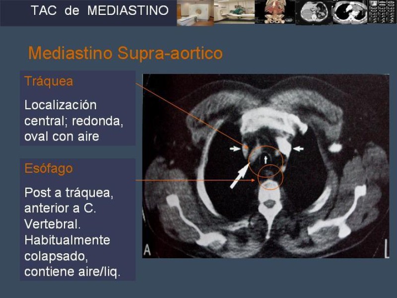 Diapositiva 7 de Imaginología Toráxica TAC