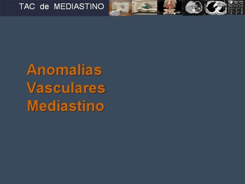Diapositiva 22 de Imaginología Toráxica TAC