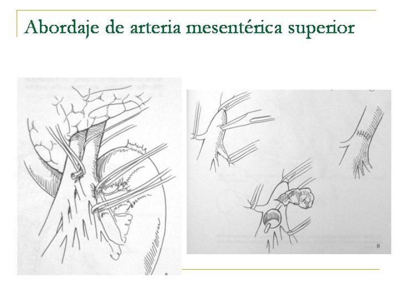 Diapositiva 75 de Accesos vasculares Abdominales