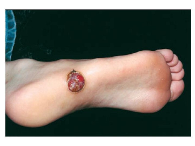 Diapositiva 20 de Melanoma