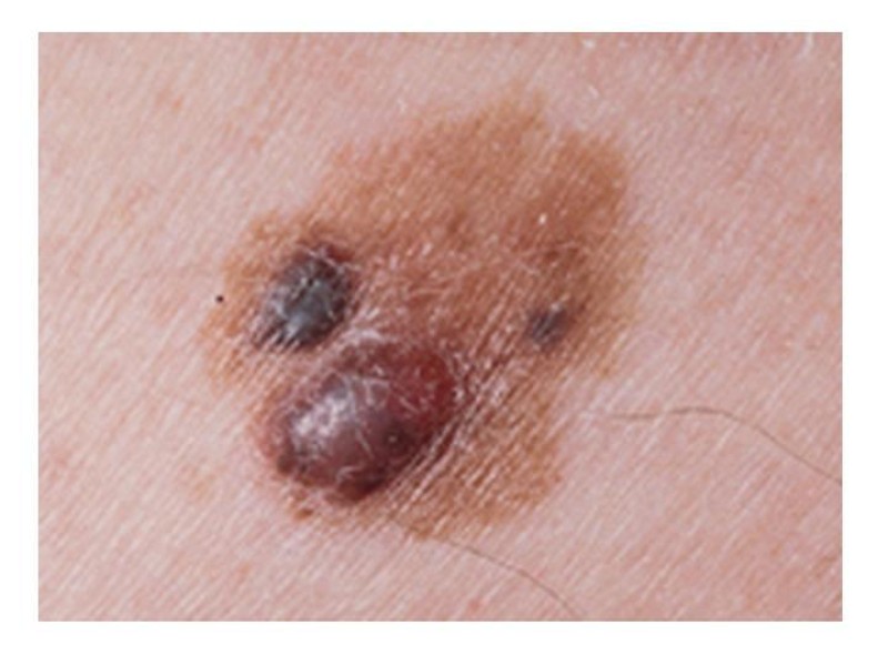 Diapositiva 23 de Melanoma