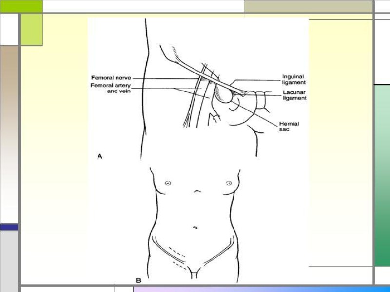 Diapositiva 3 de Tratamiento de la Hernia Femoral