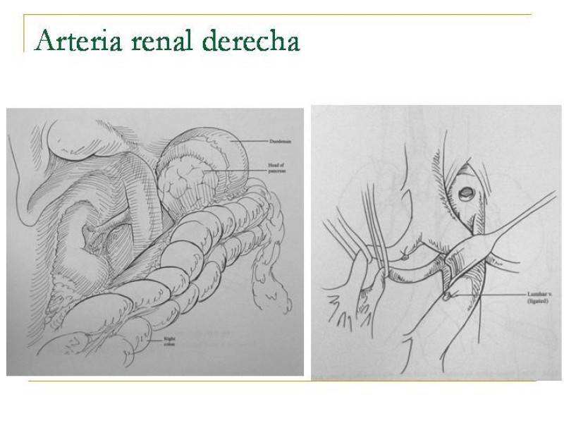 Diapositiva 89 de Accesos vasculares Abdominales
