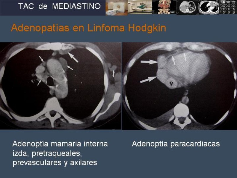 Diapositiva 32 de Imaginología Toráxica TAC