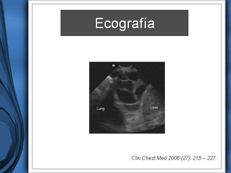 Diapositiva 13 de Empiema Pleural