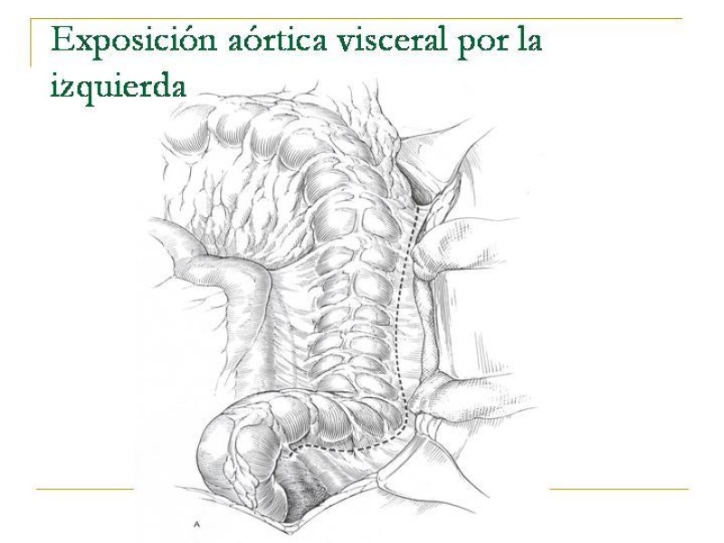 Diapositiva 26 de Accesos vasculares Abdominales