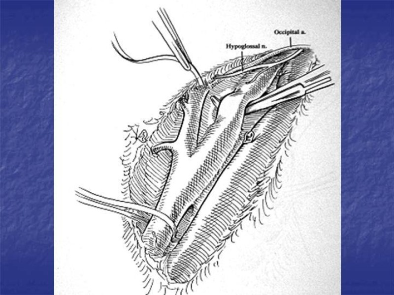 Diapositiva 32 de Abordaje Quirúrgico Vasculares