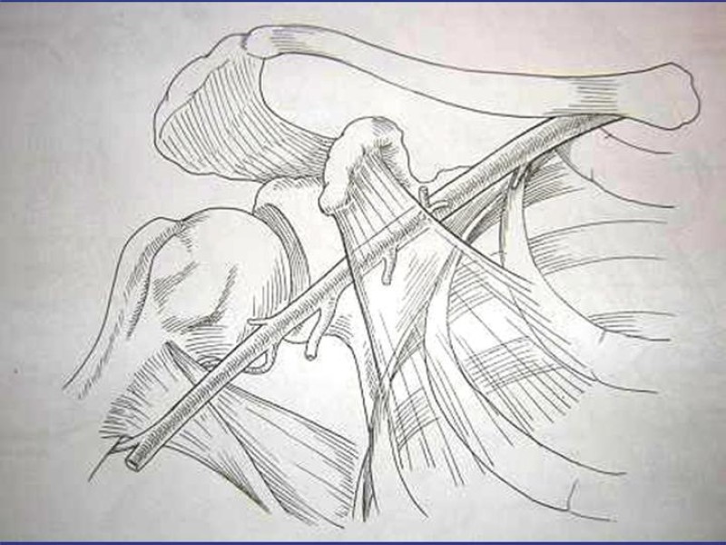 Diapositiva 54 de Abordaje Quirúrgico Vasculares