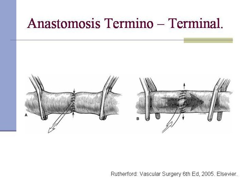 Diapositiva 22 de Reparación y Anastomosis Vasculares