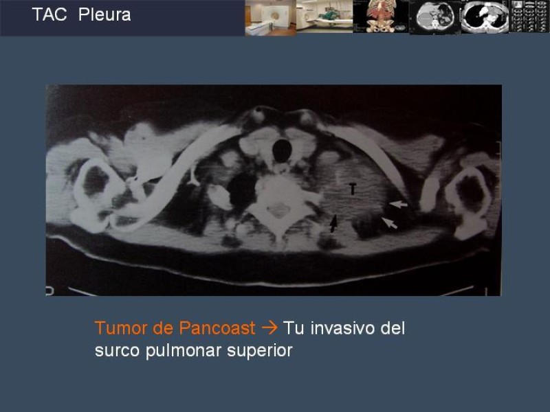 Diapositiva 71 de Imaginología Toráxica TAC