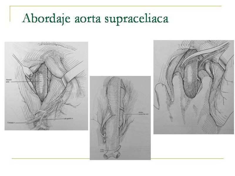 Diapositiva 17 de Accesos vasculares Abdominales