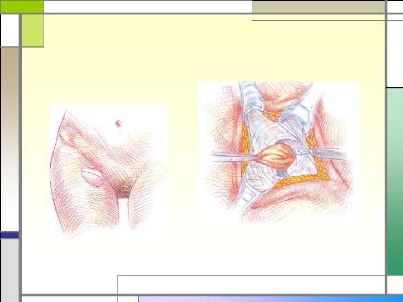 Diapositiva 13 de Tratamiento de la Hernia Femoral