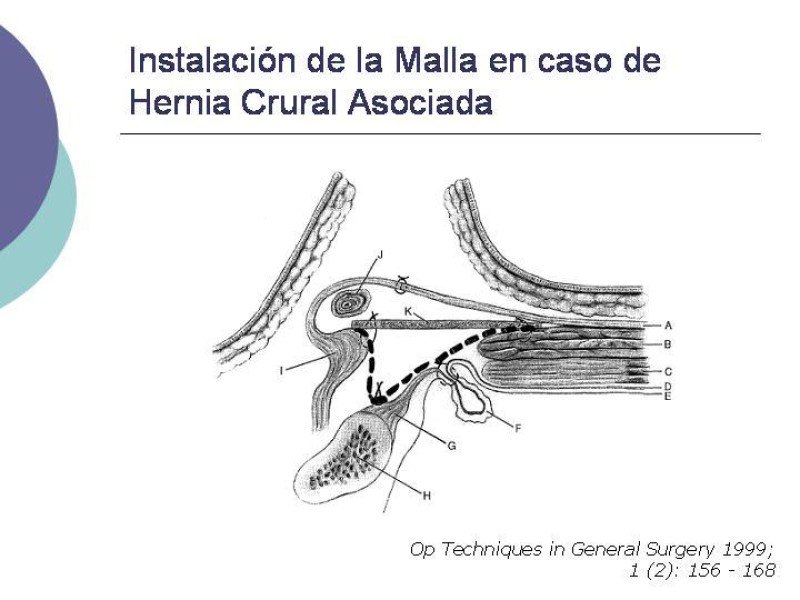 Diapositiva 11 de Hernia Inguinal: Técnica de Lichtenstein