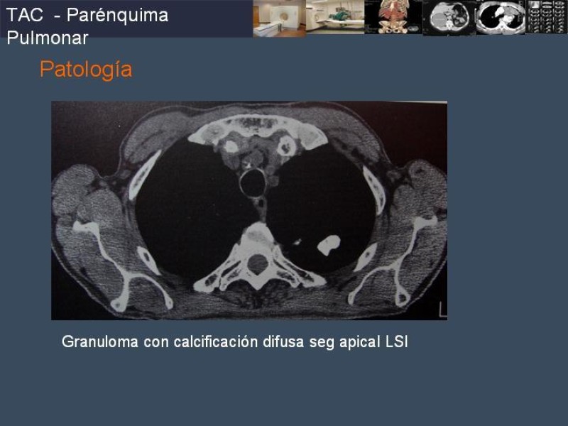 Diapositiva 60 de Imaginología Toráxica TAC