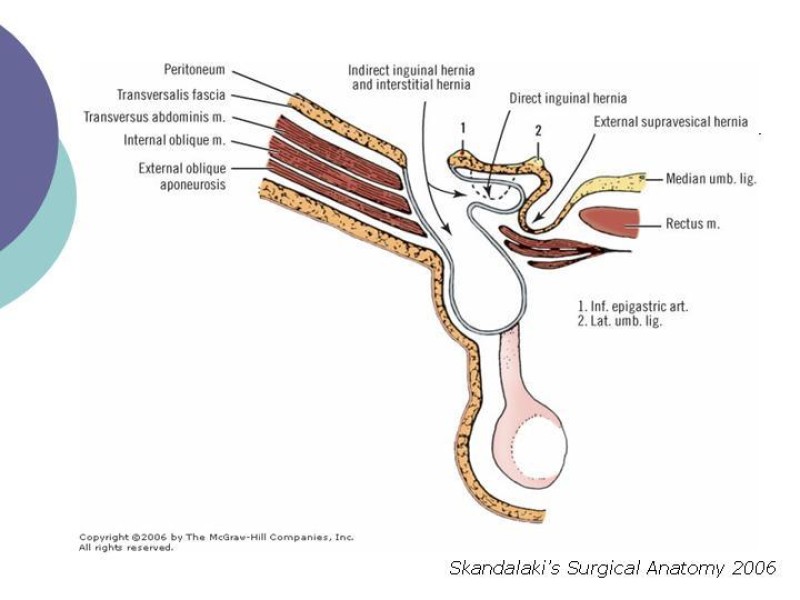 Diapositiva 2 de Hernia Inguinal: Técnica de Lichtenstein