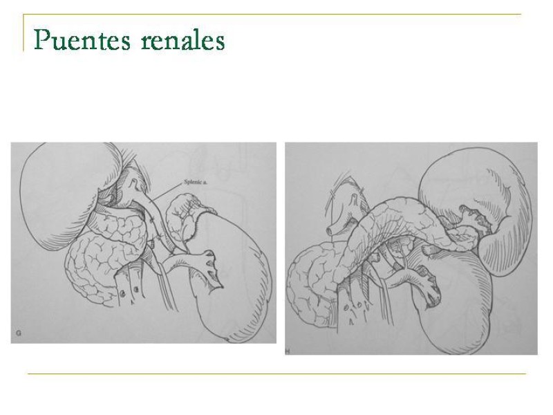 Diapositiva 92 de Accesos vasculares Abdominales