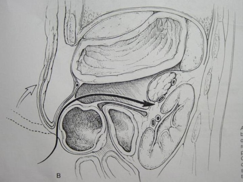 Diapositiva 67 de Accesos vasculares Abdominales