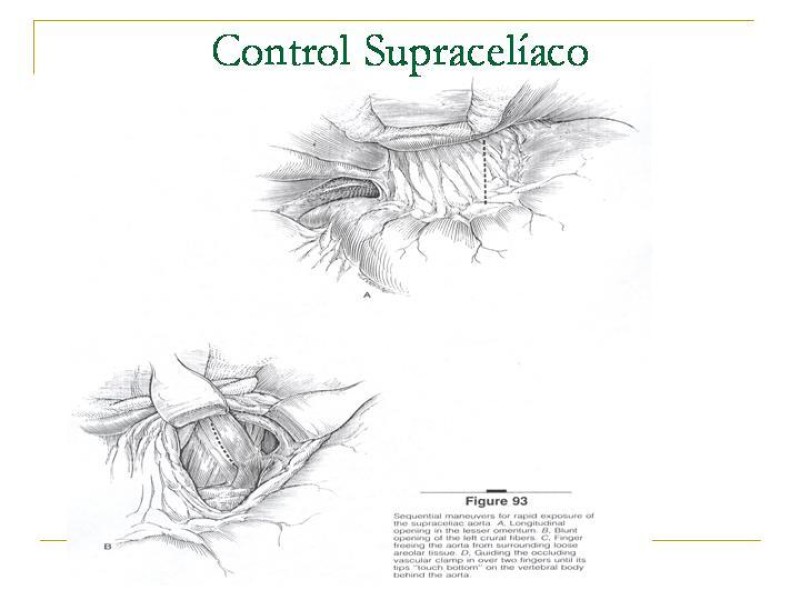 Diapositiva 13 de Accesos vasculares Abdominales
