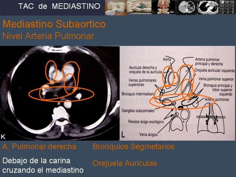 Diapositiva 18 de Imaginología Toráxica TAC