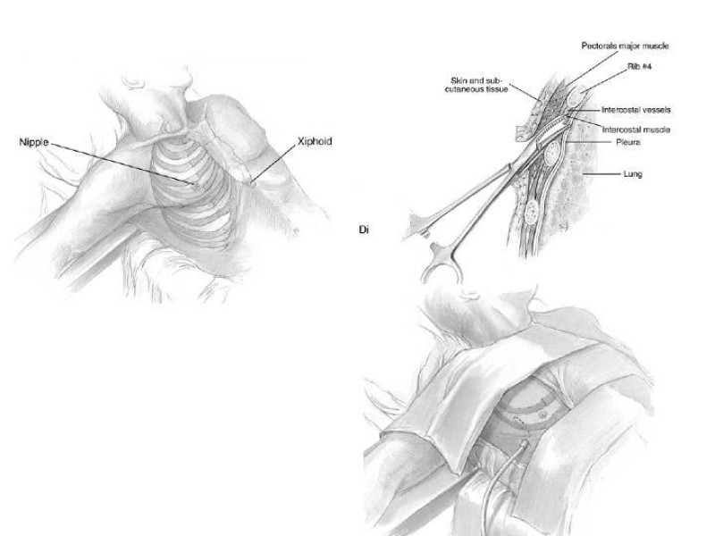 Diapositiva 9 de Hemotórax Masivo