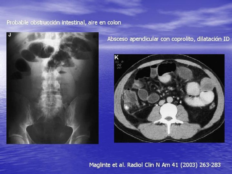 Diapositiva 12 de Obstrucción Intestinal: Estudio Diagnostico y Manejo inicial