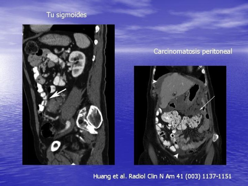 Diapositiva 22 de Obstrucción Intestinal: Estudio Diagnostico y Manejo inicial
