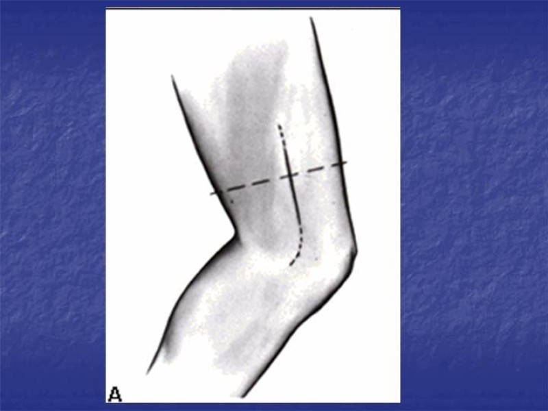 Diapositiva 97 de Abordaje Quirúrgico Vasculares